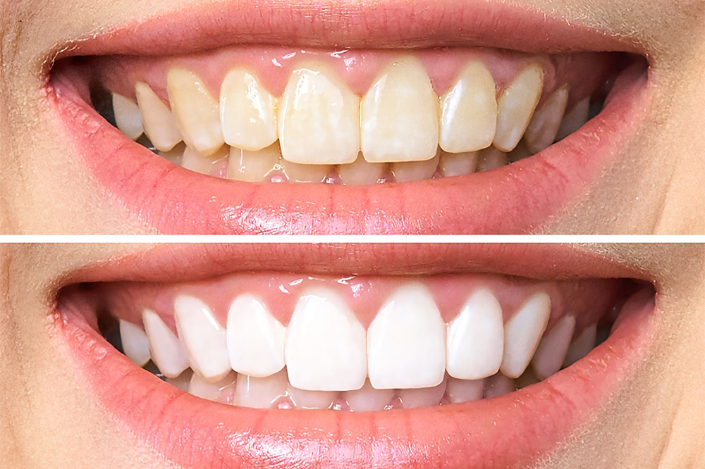 Avoid these 7 common teeth whitening mistakes